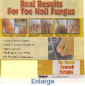 Laser Fungal Treatment