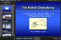 The Kalish Osteotomy