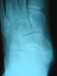 Pre Op Accessory Navicular AP