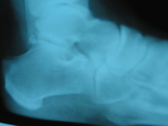 Pre Op Accessory Navicular Lateral