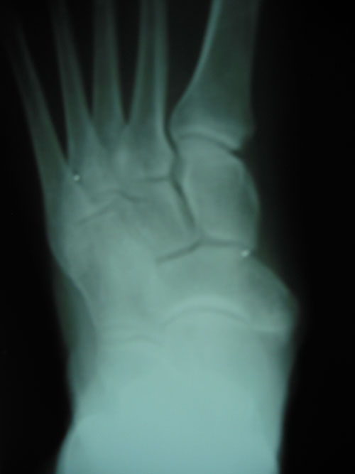 Enlarged Navicular with Os Tibialis Externum