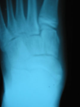 Enlarged Navicular with Os Tibialis Externum