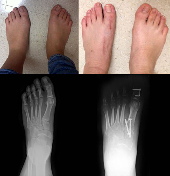 Preoperative and 13 week postoperative clinical and corresponding radiographic images