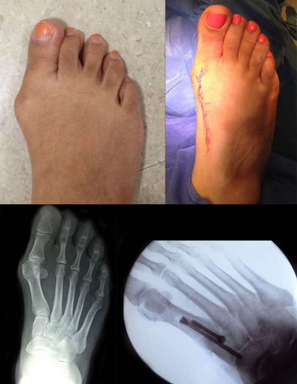 Preoperative and intraoperative clinical and radiographic images of patient's HAV deformity corrected with modified Lapidus with frontal plane rotation