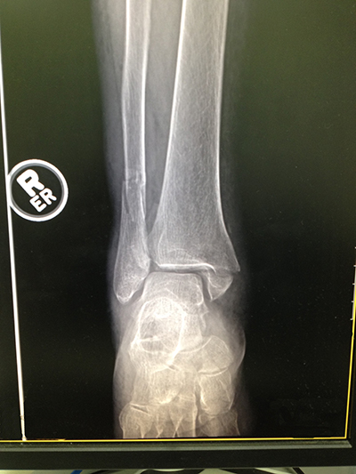 x-ray of an ankle fracture