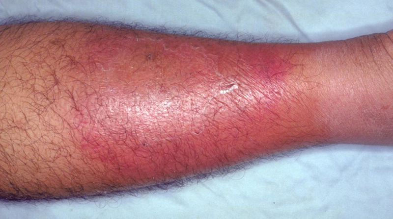 Practice Perfect 651 The Top 10 Myths About Cellulitis
