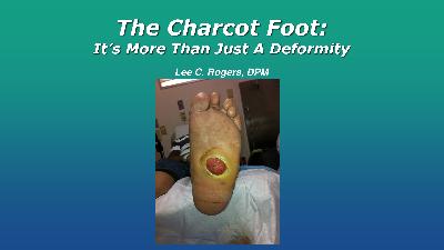 Charcot Foot - More Than A Deformity