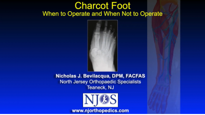 Charcot Foot: When to Operate and When Not to Operate