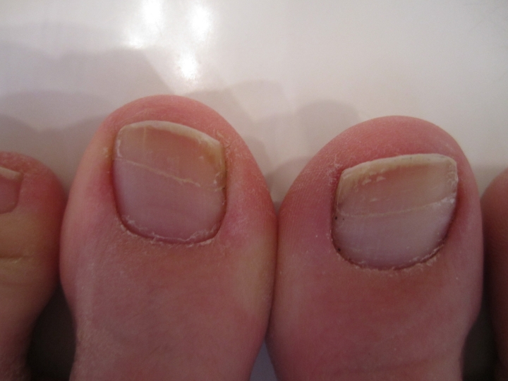 Toe Nail Discoloration And Horizontal Line