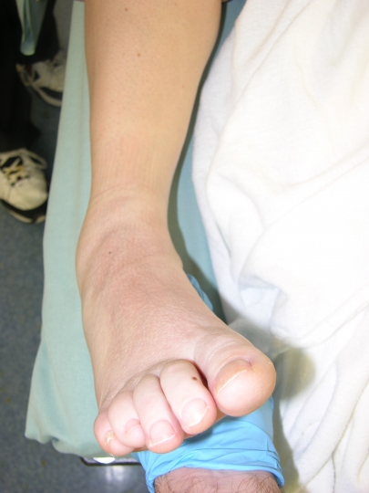 lateral ankle instability